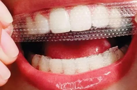 You Must Know When to Make Use of Teeth Whitening Strips