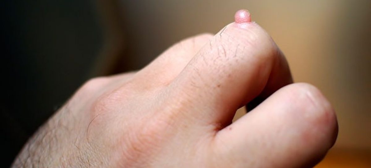 What are warts? Do they get serious?