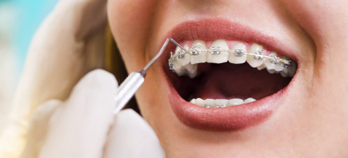 3 Tips for Keeping Your Teeth Clean During Orthodontic Treatment