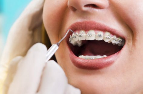 3 Tips for Keeping Your Teeth Clean During Orthodontic Treatment