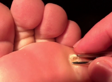 How Do You Know When A Plantar Wart Is Gone?