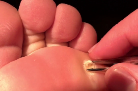 How Do You Know When A Plantar Wart Is Gone?