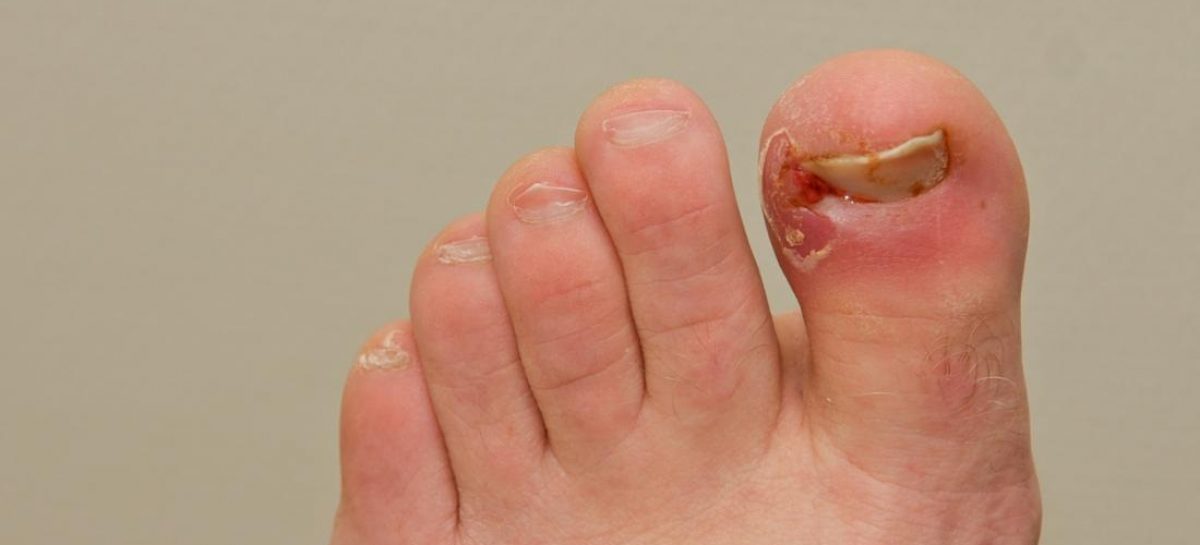 Laser Treatment Meant for Ingrown Toenails