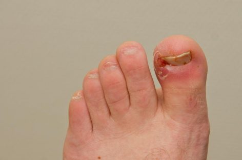 Laser Treatment Meant for Ingrown Toenails