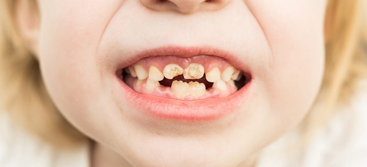 Baby Bottle Tooth Decay: A Comprehensive Guide