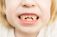 Baby Bottle Tooth Decay: A Comprehensive Guide